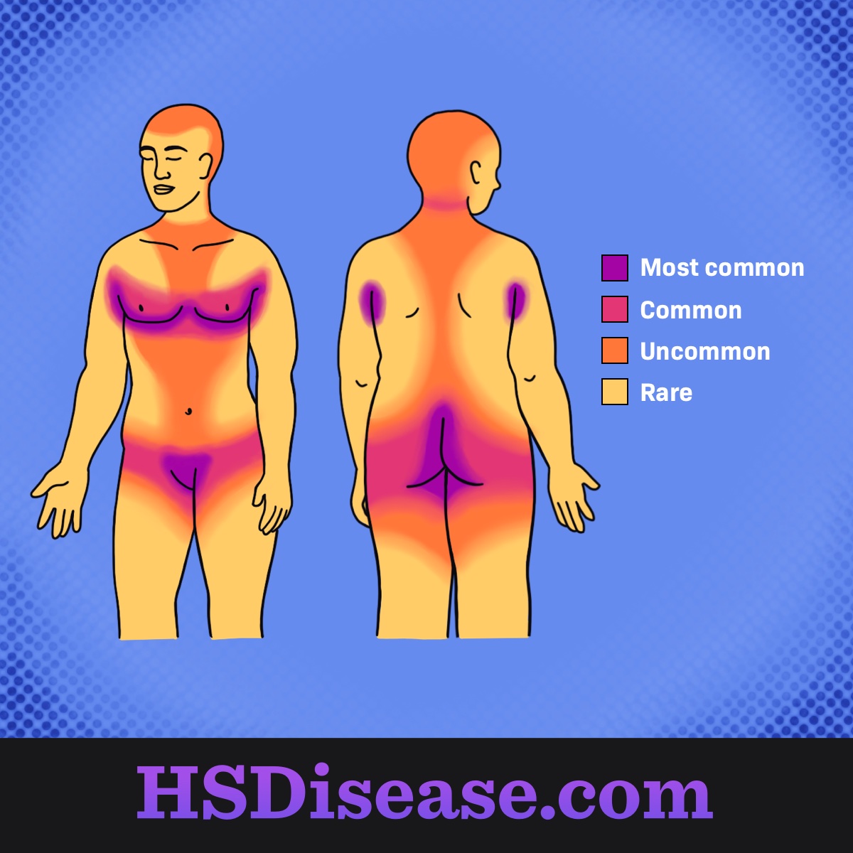 Areas of the body most affected by HS.