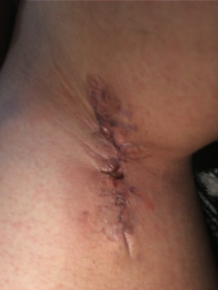 Selina's armpit after her first surgery.