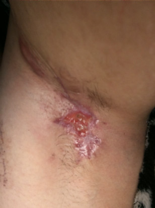 Selina's armpit before surgery