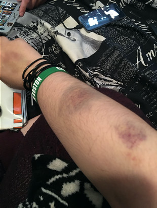 Bruising on arm